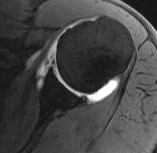 Anterior Bankart Lesion MRI